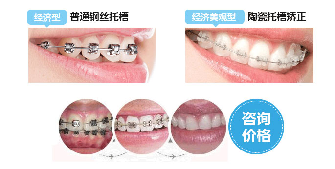 成人做完牙齿矫正后会松动吗? 成人做完牙齿矫正后会松动吗?