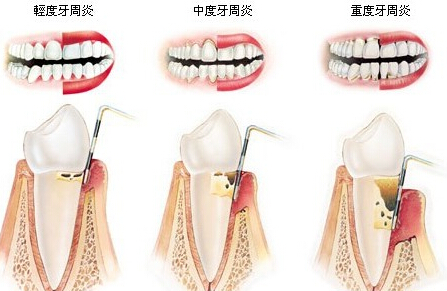 牙周病到底是如何形成的?