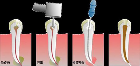 根管治疗后为什么会牙疼？